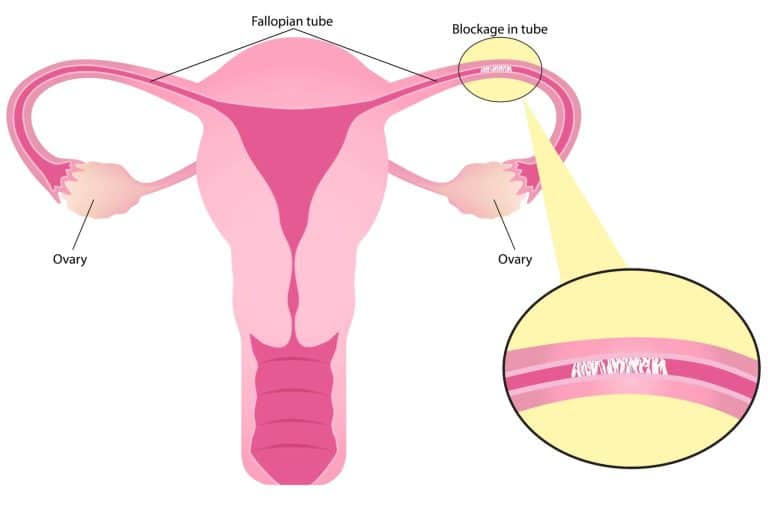 Blocked fallopian tubes