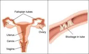 Blocked fallopian tubes (body)