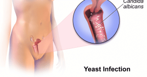 Vaginitis (Yeast Infection)