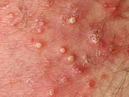 bacterial folliculitis (Vulvar skin disorder)