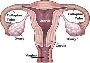 ovarian cysts