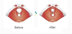 Hymenoplasty