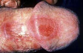 Genital Ulcer