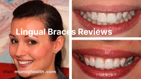 Lingual Braces Reviews