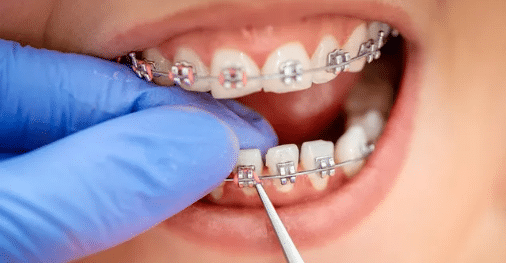 gap between teeth treatment - Seek orthodontic treatment | Bornfertilelady.com