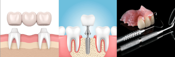 gap between teeth treatment - Consider dental implants or bridges | Bornfertilelady.com