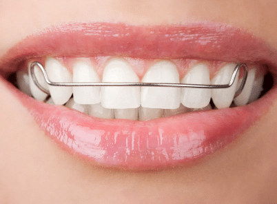 gap between teeth treatment - use retainers | Bornfertilelady.com